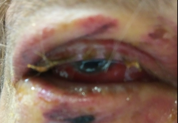 Daniel Gibson's eye was left swollen, bruised and blinded